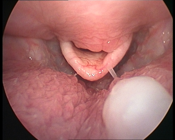 Immagine endoscopica di palato molle allungato 